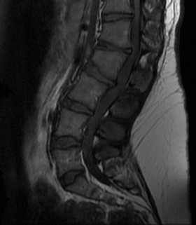 Achondroplasia MRI Spinal Stenosis.jpg